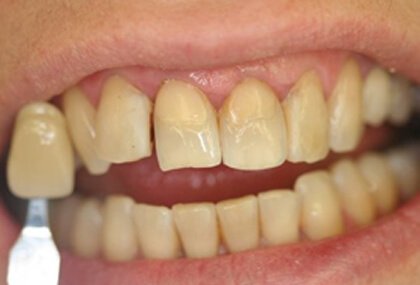 whitening-and-veneers1-before