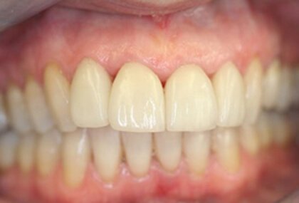 whitening1-and-veneers1-after