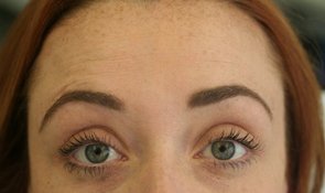Forehead-lines-after