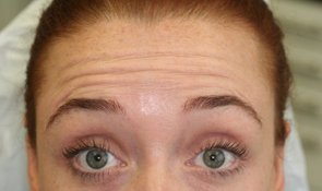Forehead-lines-before