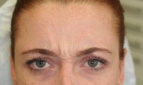 Frown-lines-before