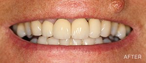 after-implants