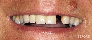 before-implants